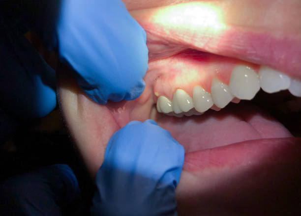 Best Emergency Dentist for Lost Fillings or Crowns in Millport, AL